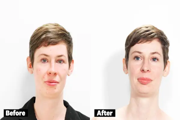Jessie Van Amburg glycolic peel before and after