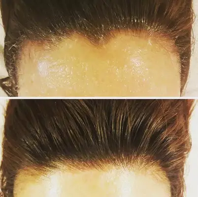 hairline-microblading