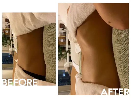 Brazilian lymphatic drainage massage before and after
