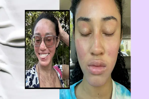 A Guide To Topical Steroid Withdrawal Syndrome