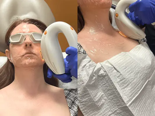 Ashley Rebecca during her IPL treatment