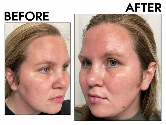 Photos of person’s face before and after using Dr. Dennis Gross Alpha Beta Universal Daily Peel