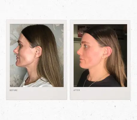 forma laser treatment—Sacha Strebe