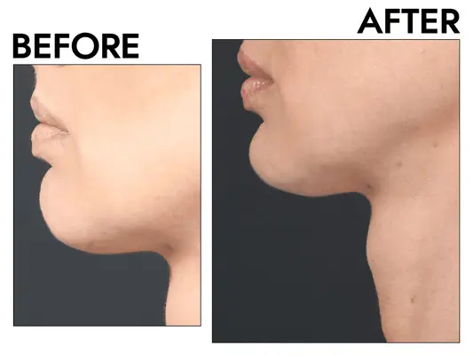 chin filler before and after photo
