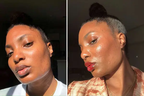 cosrx acne pimple master patch