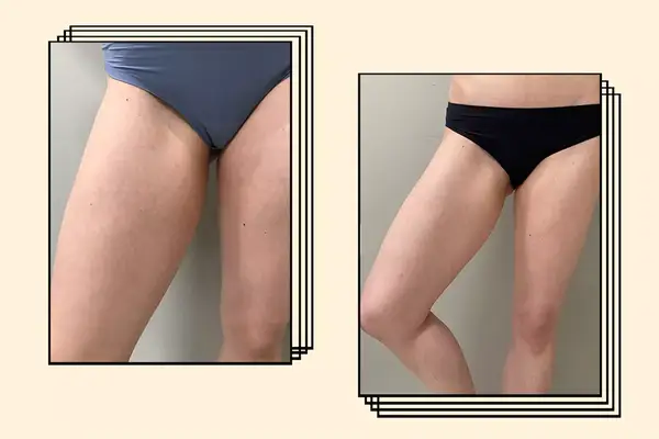 Before and after a TruSculpt ID device session on a woman