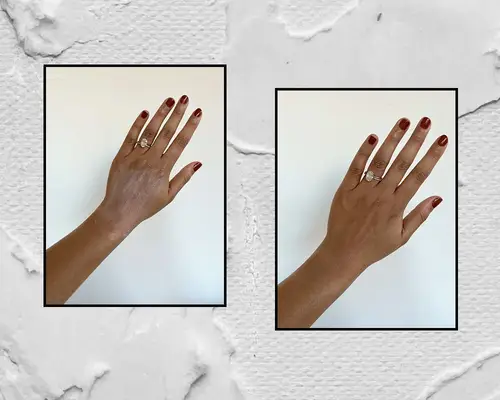 Toral Vaidya hands before and after