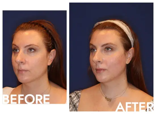 Emface treatment botox alternative before and after photo
