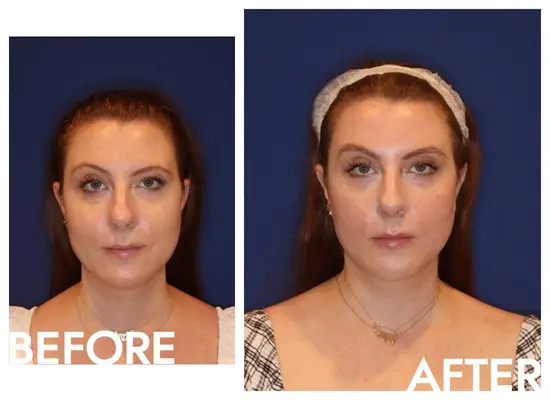 Emface botox alternative before and after