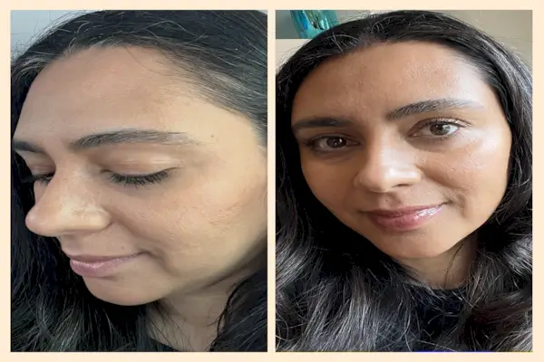 J'ai essayé un nouveau produit injectable pour améliorer la texture de ma peau et maintenant, mon teint est plus lisse que jamais