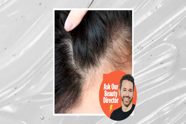 The Truth About Ozempic And Hair Loss