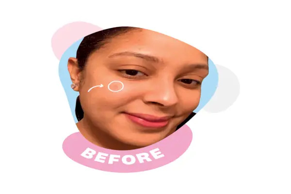 Cosa è successo quando 4 donne hanno provato il cerotto per brufoli ZitSticka