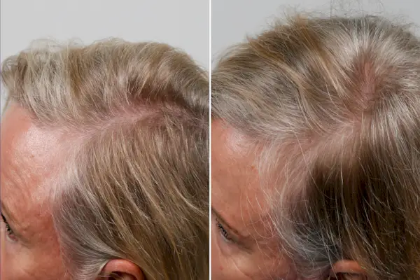 ‘Este dispositivo a laser ajudou meu cabelo a crescer novamente após a Covid – quando nada mais o faria’