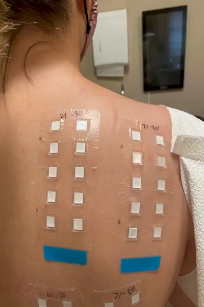 il mio patch test allergico