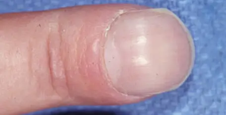 unghie da bastonatura