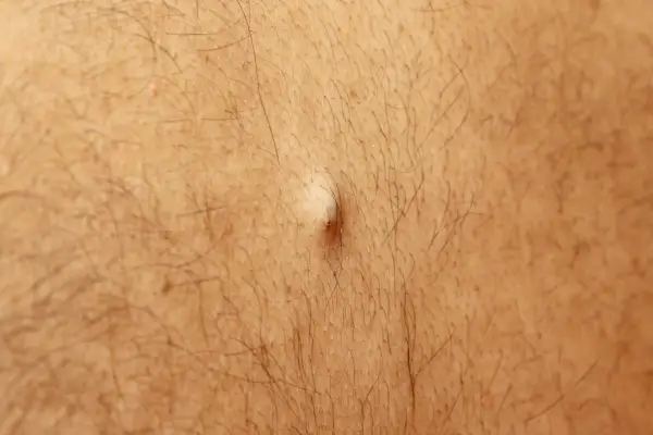 Talgzyste auf dem Rücken des Mannes