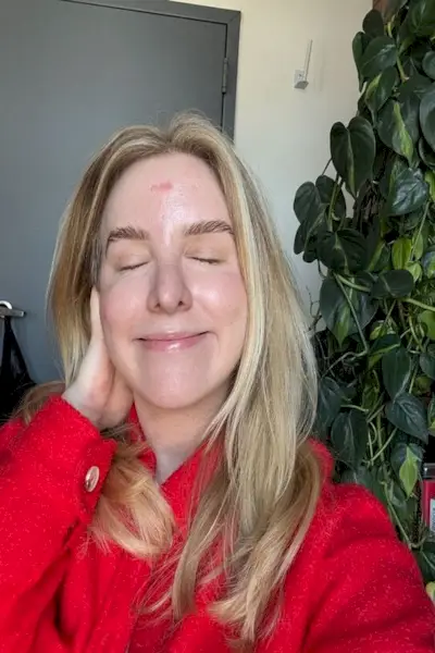 La scrittrice Emily Haley mostra la sua cicatrice nei mesi successivi alla procedura per rimuovere il carcinoma basocellulare dalla fronte.