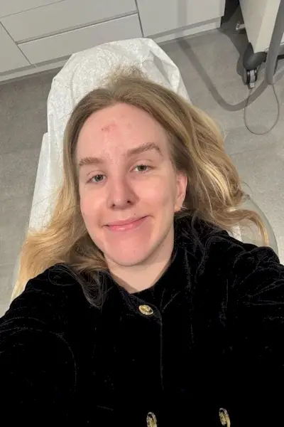 Emily Haley mostra la sua cicatrice nei mesi successivi all'intervento chirurgico per rimuovere il carcinoma basale.