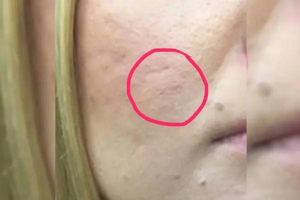 Möglicherweise hat der Dermaroller beim Testen diese weiße, erhabene Beule in meinem Gesicht verursacht