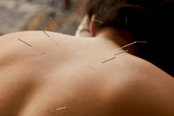 Woman having acupuncture done on her back in a clinic