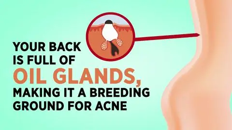 27 questions majeures sur l'acné que tout le monde se pose – auxquelles répond le Dr Pimple Popper