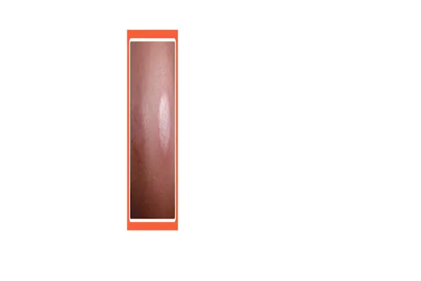 Kopřivka nevypadá stejně na všech tónech pleti, zde je návod, jak ji identifikovat na černé pleti