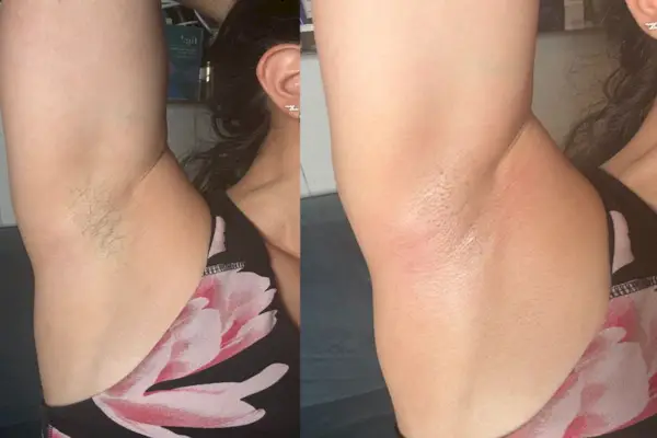 før og efter voksning af armhulerne