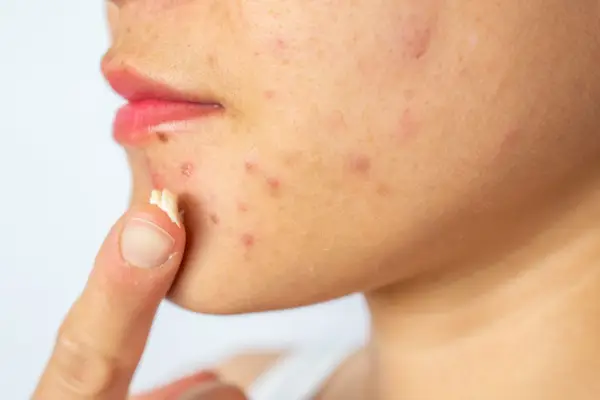 Woman applying acne cream on her face for solving acne inflammation (Papule and Pustule) on her face.