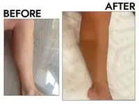 Before and after using at-home laser hair removal device