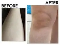 Before and after of a leg using at-home laser hair removal device
