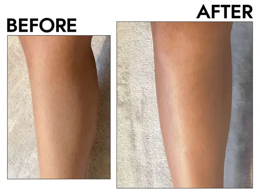Before and after using at-home laser hair removal device