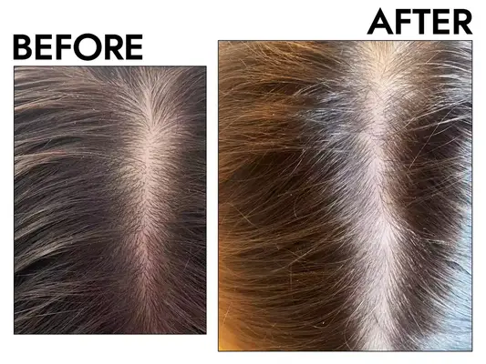 Photos of person’s hair before and after using Jupiter Balancing Dandruff Shampoo