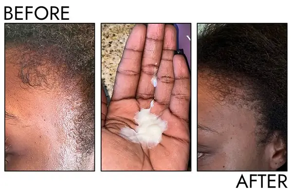 Photos of person’s hair before and after using Virtue Minoxidil 5% Hair Growth Treatment