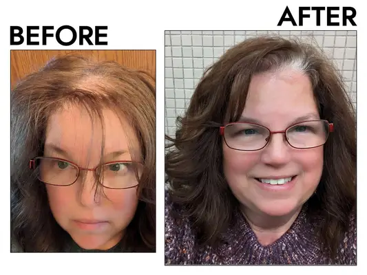 A before and after photo showing the effects of using Rogaine Women