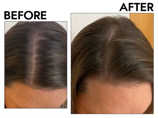 Photos of person’s hair before and after using Rogaine Women