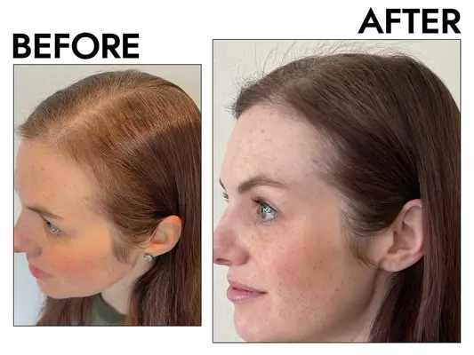 Advanced Trichology NutraM Topical Melatonin Hair Growth Serum