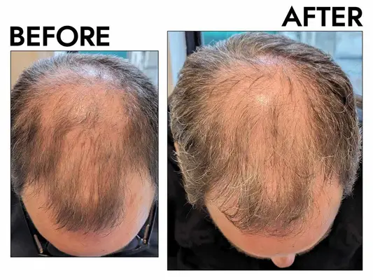 A before and after photo showing the effects of using BosleyMD Men