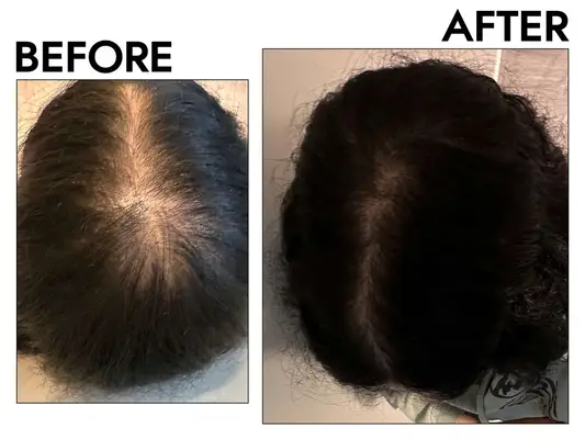 A before and after photo showing the effects of using hers Minoxidil Foam for Women