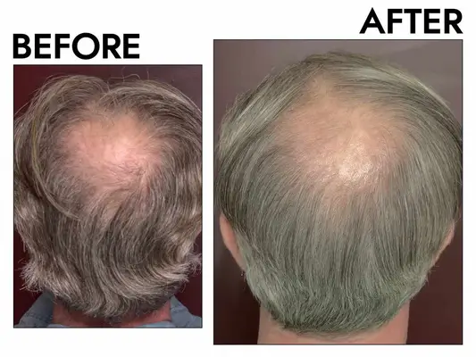 A before and after photo showing the effects of using Keeps 5% Minoxidil Foam