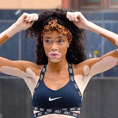 A person with vitiligo wearing a sports bra and headband, holding their arms in a raised position