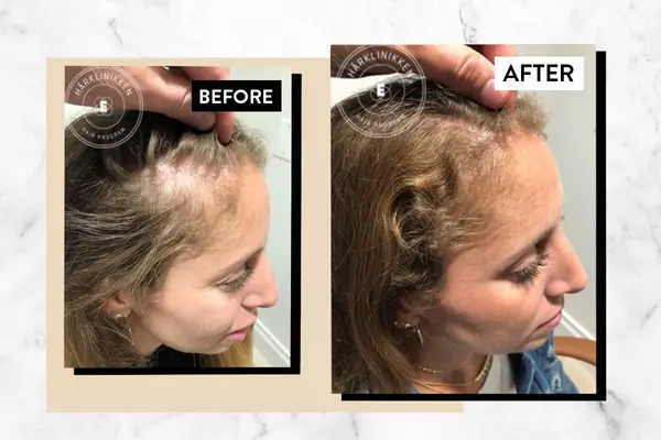 Ho provato Harklinikken, il vivace sistema scandinavo della crescita dei capelli