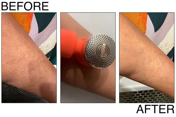 Two people using at-home laser hair removal devices on their underarms