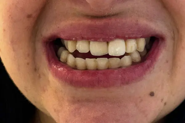A person before applying HeySmile Teeth Whitening Kit