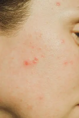 Woman with acne