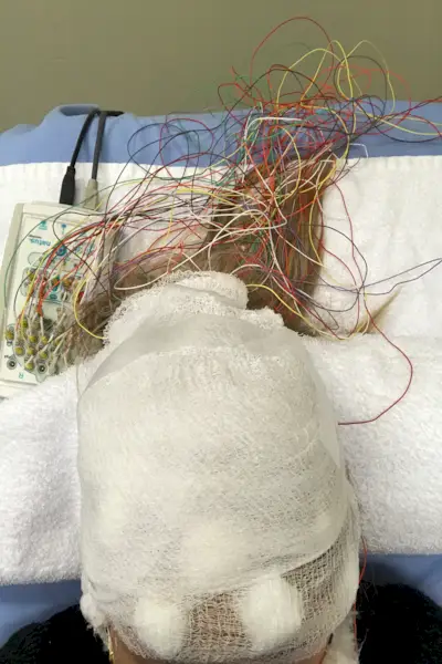 Briar Nolet Epilepsi Diagnose EEG