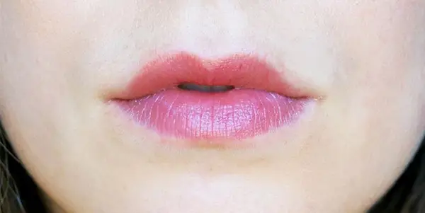 After derma-rolling lips.