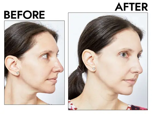 Photos of person’s face before and after using Jane Iredale PurePressed Base Mineral Foundation Refillable Compact Set