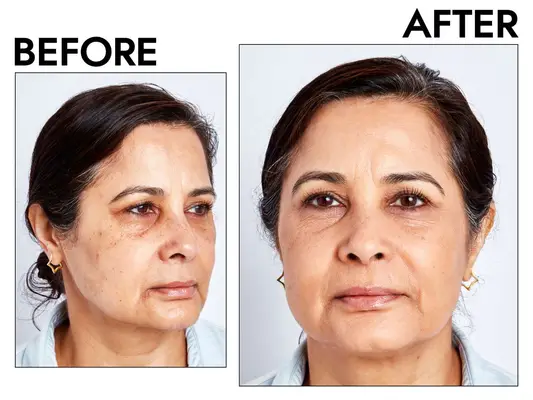 Photos of person’s face before and after using Westman Atelier Vital Skin Foundation Stick