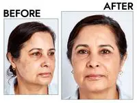 Photos of person’s face before and after using Westman Atelier Vital Skin Foundation Stick