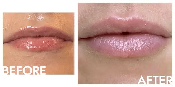 lip filler before and after photo close up